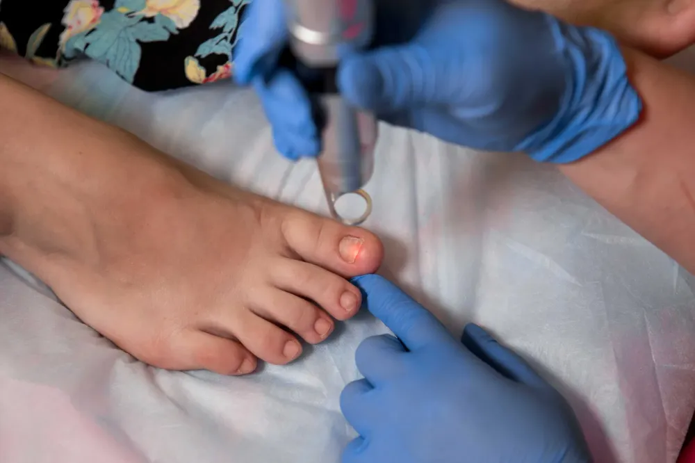 Ongle incarné près de Chessy